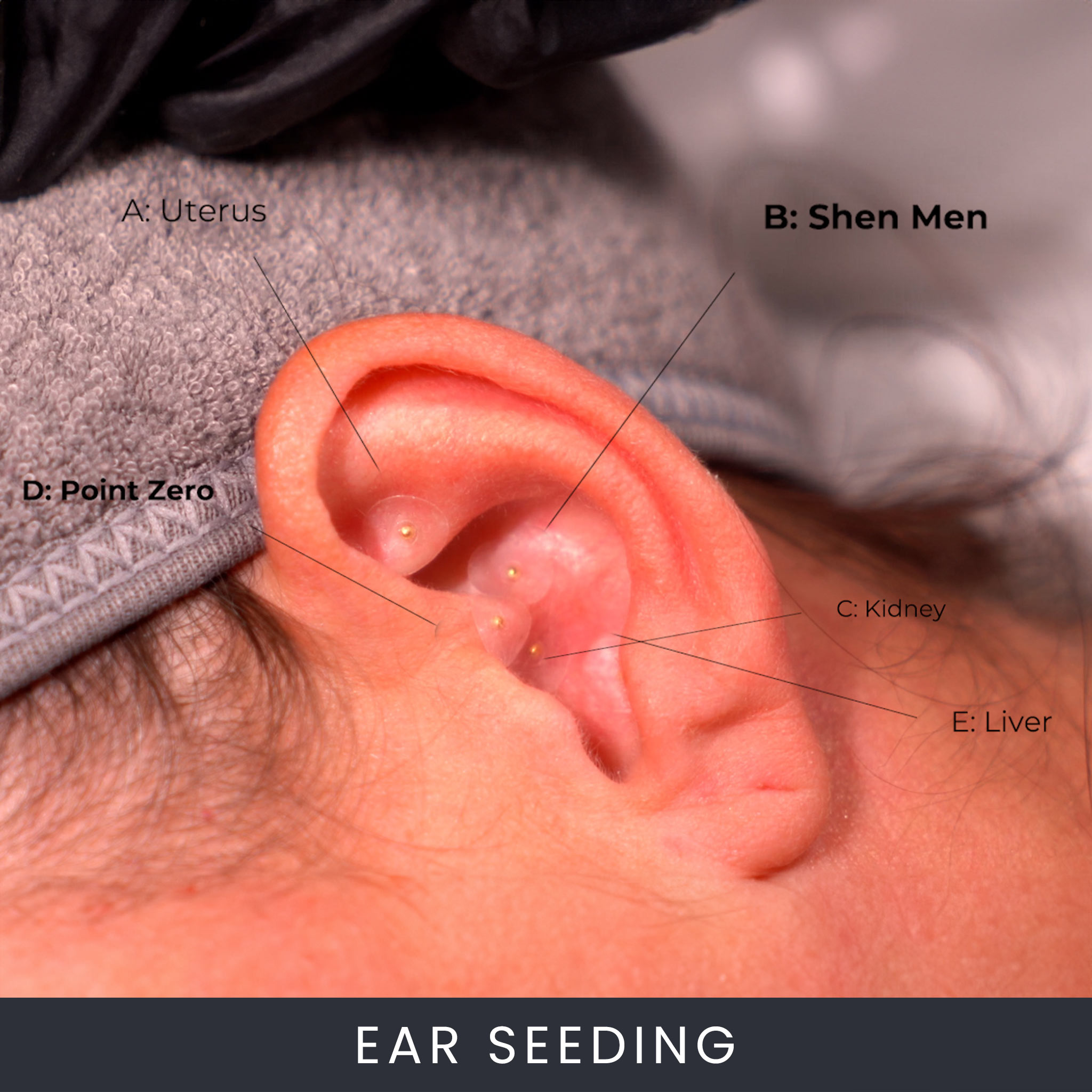 Online Ear Seeding – Auricular Therapy Course