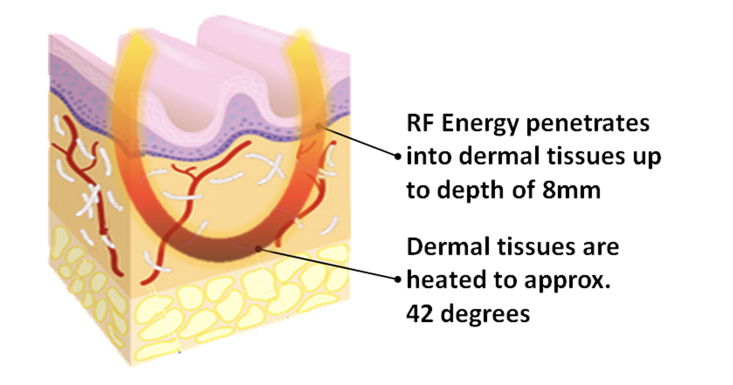 How does Radio Frequency (RF) work? Hampson Training Academy