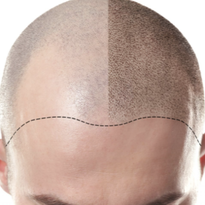 scalp micro-pigmentation