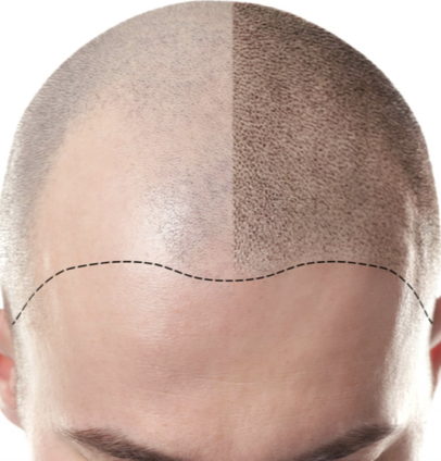 scalp micro-pigmentation