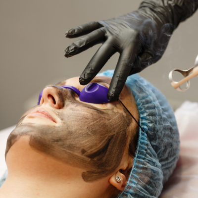 Carbon Laser Facial