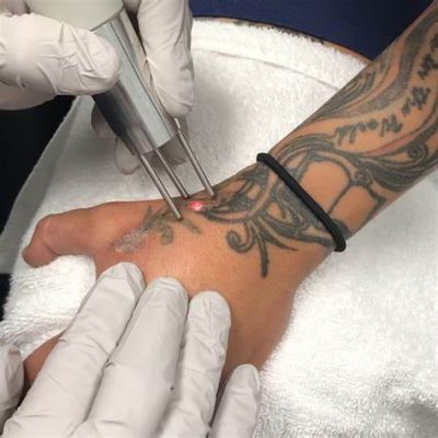 Tattoo Removal