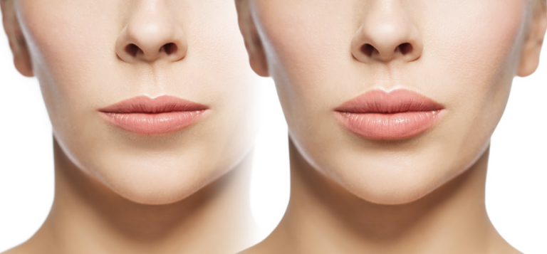 Carbon Laser Lip